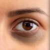 Dark Circles & Marks