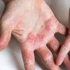Eczema