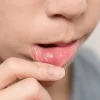 Mouth_Ulcers_Home_Remedies_bb743030-735a-4476-a20c-c253f850f6d4